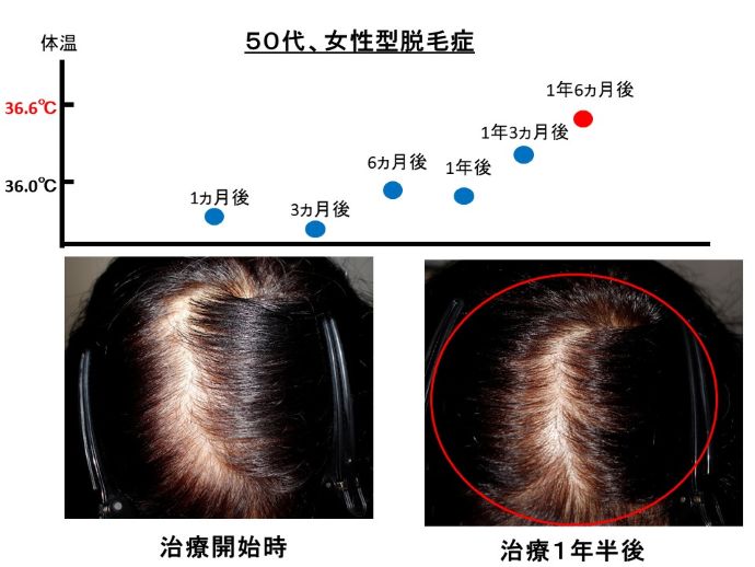 円形脱毛症　病院